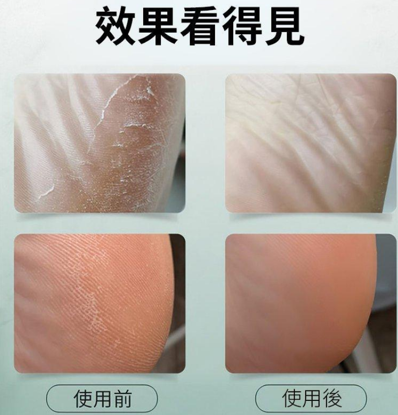 德國西門子充電式電動修腳器 磨腳皮去腳皮死皮刀老繭磨腳神器修足機